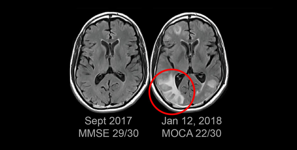 MRI of swelling in the brain